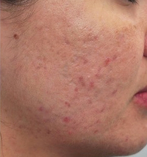 cosmetic-acne-before